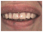 Dental Implants Dentist in Patchogue